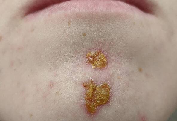 impetigo