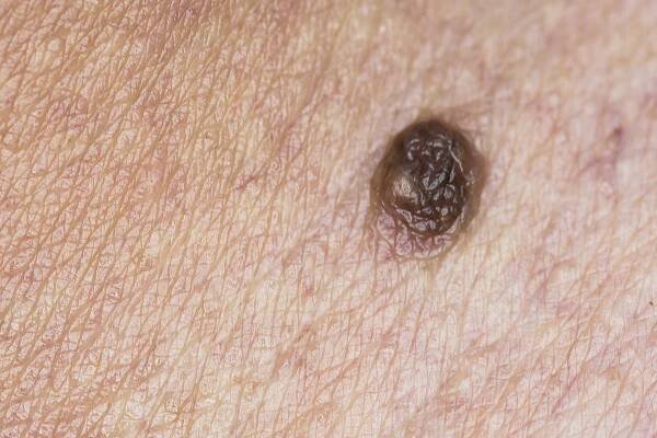Stařecké bradavice nejsou zdraví nebezpečné. Pozor však na záměnu s melanomem