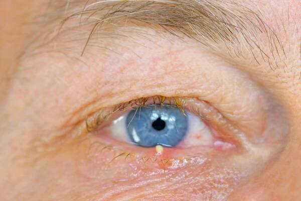 Eyelid Bumps 101: How to Identify Styes, Milia & Pimples | Allure