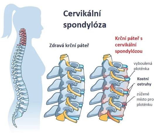 Cervikální spondylóza - ilustrace