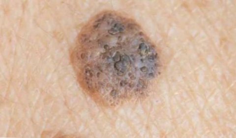Rozdíly mezi seboroickou keratózou a melanomem