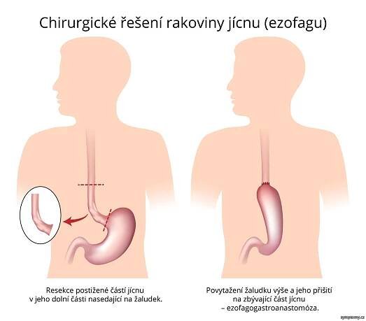 Operační řešení rakoviny jícnu - příznaky a léčba
