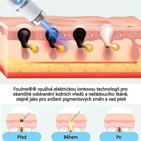 Foulme® Laserové pero na bradavice a znaménka🔦🔦 - neinvazivní a bezbol – Trepath Store