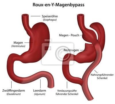 Žaludeční bypass Roux-en-Y Popis německý