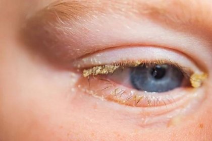 Demodekóza očních víček nebo roztočů - léčba léky a doma