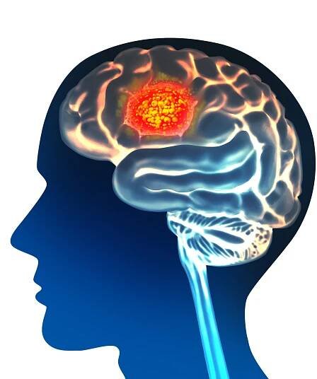 Koncept anatomie karcinomu mozku a symbol zhoubného nádoru jako neurologická část těla s mikroskopickým zvětšením maligních buněk dělících a šířících se 3D ilustračními prvky. — Stock obrázek