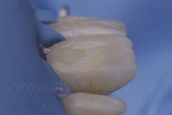 tooth after microabrasion of brown spot