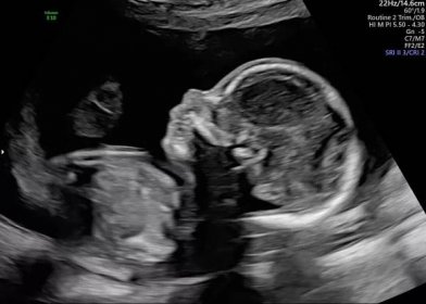 Prenatální diagnostika – FNO porodnice