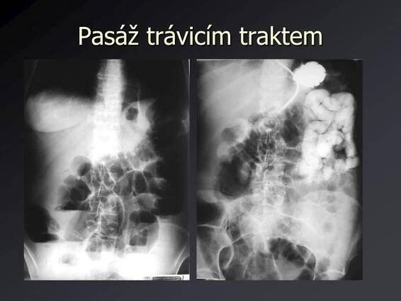 PPT - Pasáž trávicím traktem PowerPoint Presentation, free download - ID:5785945