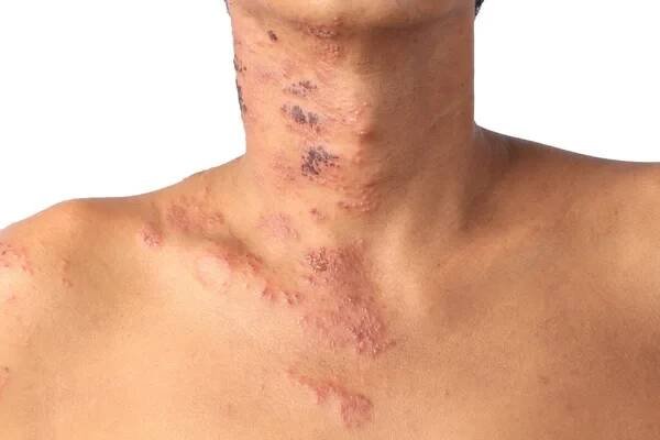 Herpes zoster nebo pásový opar nebo Zoster; příznak je infikován virem Varicella Zoster nebo VZV. je virové onemocnění charakterizované bolestivou kožní vyrážkou s puchýři v lokalizované oblasti. Vyrážka se vyskytuje v jedné části, široké svědění na boku těla — Stock obrázek
