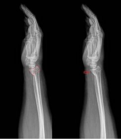 Zlomeniny predlaktia a zápästia - Medicína a chirurgia
