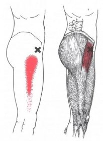 Bolest na zevní straně stehna a bolest kyčle - příčiny - Spoušťovýbod