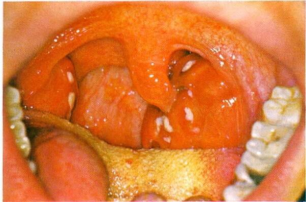 Tonsillitis acuta