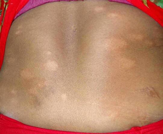 Clinical image of borderline lepromatous leprosy shows multiple erythematous infiltrated plaques over the back of a female with skin of colour. Note the imperfect asymmetry.