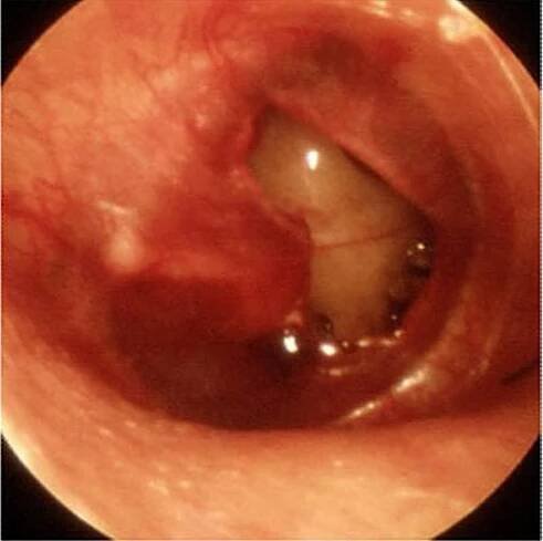 Eardrum Perforation - Ear, Nose, and Throat Disorders - MSD Manual Consumer Version