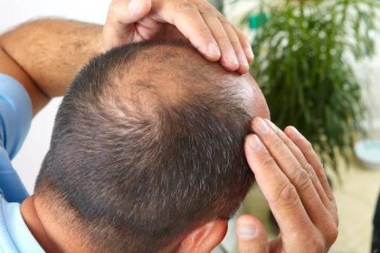 Ztráta bývalé krása: pleš 
 
 
Vypadávání vlasů u mužů je velký problém, který přináší spoustu nepříjemností. Androgenetická alopecie je dědičná a může se přenášet přes otce nebo matku. Mužova matka může být majitelkou nádherného mopu vlasů, ale předá gen pro plešatost svému synovi.
 
 
Vypadávání vlasů u některých mužů může začít již ve 20 letech a je to způsobeno množstvím testosteronu, který dokáže odměnit husté vlasy po celém těle, ale okrádá vlasy na temeni.
 
 
Známky androgenní alopecie jsou vypadávání vlasů na čele a temenní oblasti, při zachování jejich hustoty na spáncích a v zadní části hlavy. Tak vzniká silný charakteristický lem.
 
 
Trichologové říkají, že hádat se a bojovat s přírodou není tak snadné a někdy je to zbytečné. Použití všech moderních technologií může poskytnout pouze dočasný účinek a zpomalit proces. Existují ale jen dva způsoby, jak problém radikálně vyřešit: transplantace vlasů, nebo změna image, jako to udělali Bruce Willis nebo Fjodor Bondarchuk.
 
 Hledejte ženu 
 
