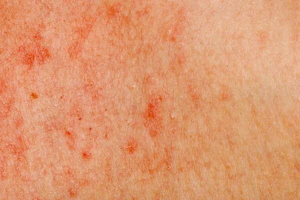 Contact dermatitis is caused by a reaction to allergens like soap and detergent