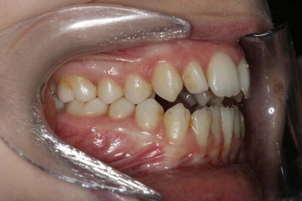 Bite Problems | Contour Orthodontists