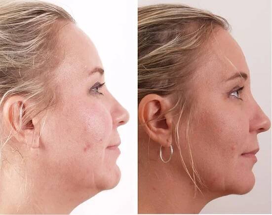 Facelifting a omlazení pokožky obličeje | Slevomat.cz