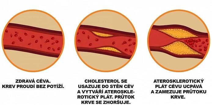 Jedno dítě ze 400 má zvýšený cholesterol. Jak to zjistit a co s tím