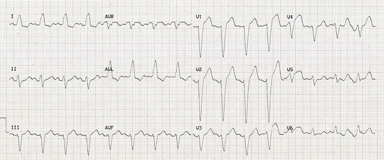 ECG LBBB, broad QRS, Dominant S wave, Absence lateral Q wave, appropriate discordance