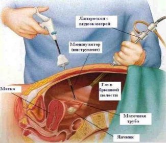 Laparoskopie v gynekologických indikacích a výhodách / Gynekologie | Užitečné informace a tipy na péči o sebe. Zdraví, výživa