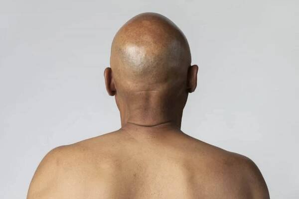 druhy alopecie