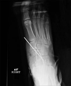 Degloving injury | The Foot and Ankle Online Journal