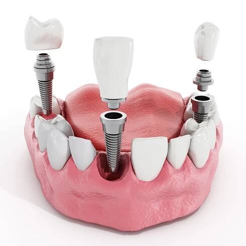 Naše zubné implantáty vám vyčaria úsmev