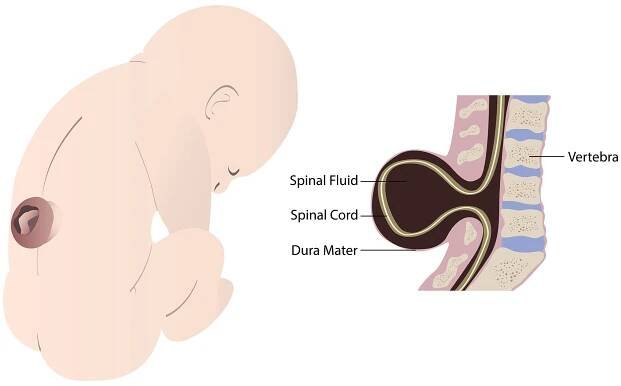 Infographic showing spina bifida