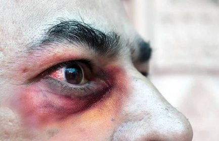 Lékaři musí kvůli "černé plísni" amputovat oči a části obličeje. Nemoc vzniká v důsledku indické mutace koronaviru - Mix24.cz