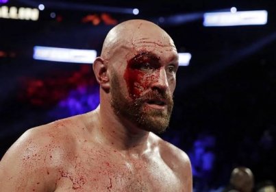 Tyson Fury suffered a horrendous cut against Otto Wallin that needed 47 stitches in afterwards