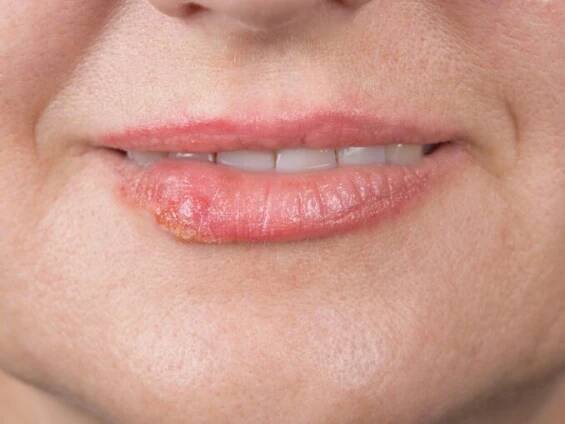 Spolehlivá a jednoduchá domácí léčba viru herpes simplex