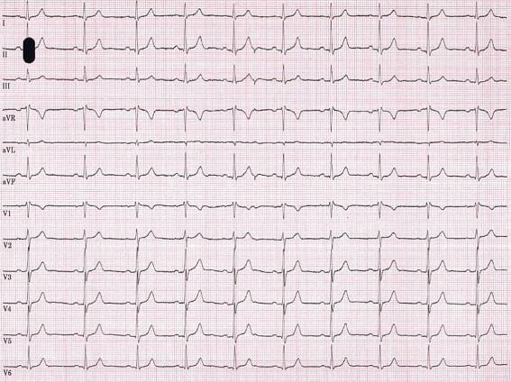 Rechtsschenkelblock im EKG - Fokus-EKG