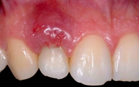 Opuch dásní v oblasti zubů způsobuje, diagnózu, léčbu / Terapeutická stomatologie