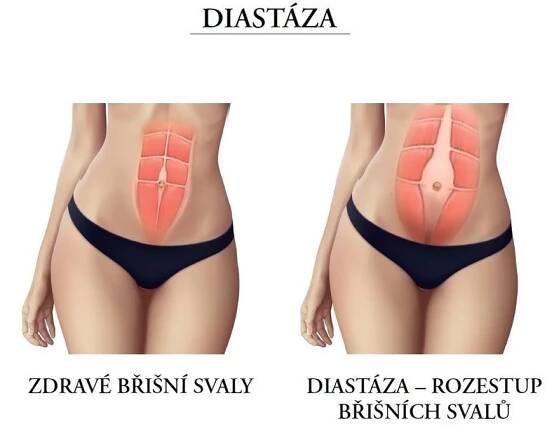 Úleva pro rodičky, kýlaře i pupkáče: Lékaři v Brně umí šetrně spravit povadlé břicho