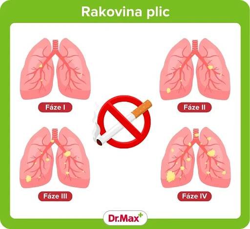 Rakovina plic – příznaky, léčba a prevence | Dr. Max
