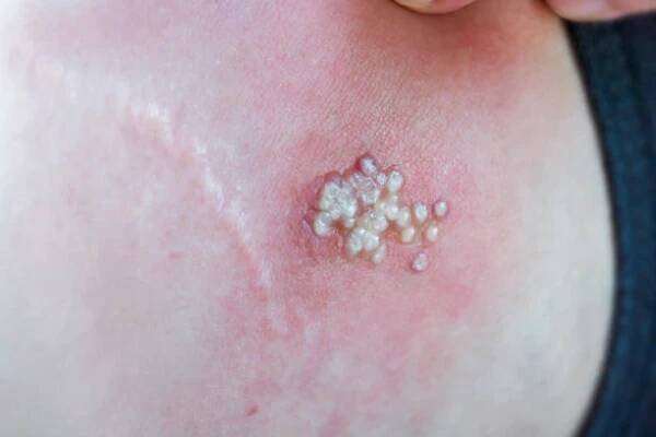 žena s šindele nebo herpes zoster na kůži, to je zvednuté červené hrboly a puchýře způsobené na těle. léčba léčby varicella-zoster virus infekce koncept. - herpes zoster - stock snímky, obrázky a fotky