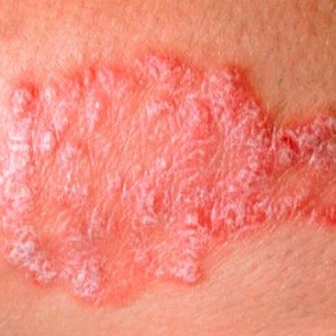 Psoriáza u dětí: příčiny a léčba, symptomy a příznaky u kojenců, jak se léčit, zda dětský krém pomáhá, zda je zděděn od