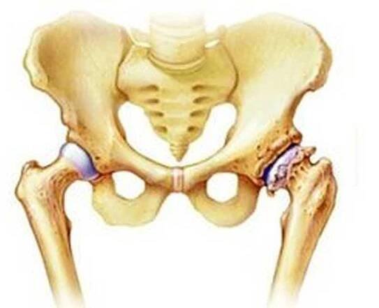 Osteoartróza kyčelního kloubu / Osteoartróza