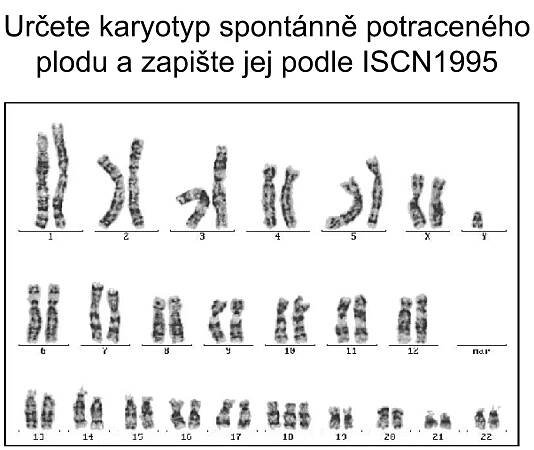 Určete karyotyp spontánně potraceného plodu a zapište jej podle ISCN1995 