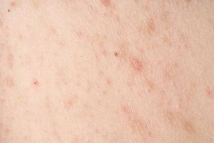 Kůže Akné Červenými Skvrnami Zdravotní Problém Kožní Onemocnění Zblízka Alergická — Stock fotografie