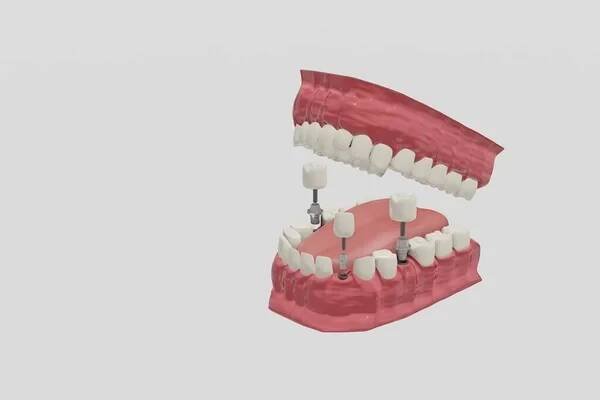 Zubní implantáty Procedura léčby. Lékařsky přesný 3D ilustrační zubní protézy koncept. — Stock obrázek