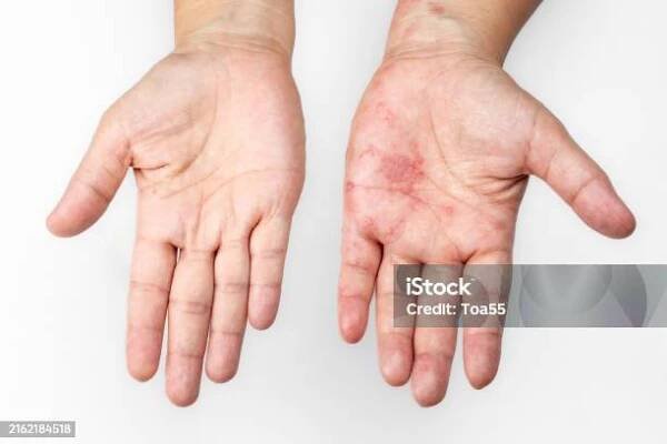 Stock fotografie Pásový Opar Zoster Nebo Herpes Zoster Příznaky Na Paži – stáhnout obrázek nyní