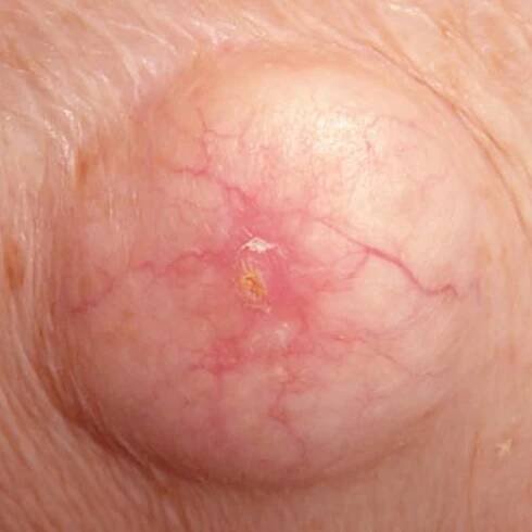 Lumps and Bumps – Epidermoid Mass and Lesion
