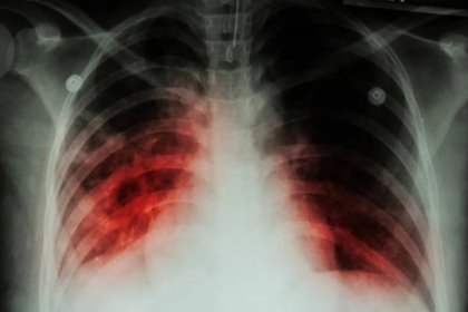 Zápal plic představuje vážné ohrožení života. Jak poznat, že vás trápí a kdy volat záchrannou službu?