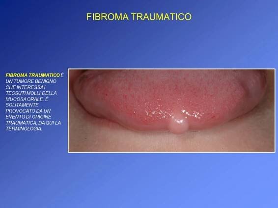 Patologie orali pediatriche » Dott. Mariani Umberto || Patologia orale e Medicina