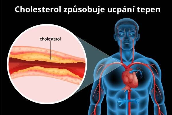 Cholesterol způsobuje ucpání tepen