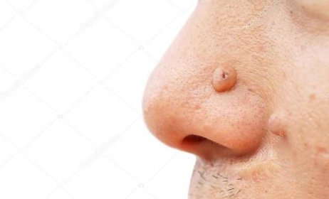 Stáhnout - Krtek na obličej a nos izolované na bílém — Stock obrázek