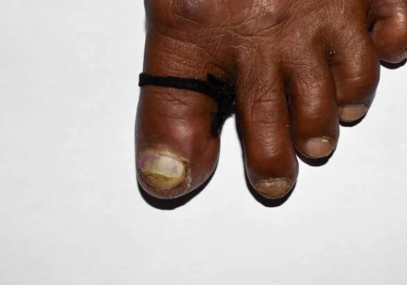 akutní paronychie a škrtidlo u palce muže jihovýchodní asie. - black man foot pain - stock snímky, obrázky a fotky